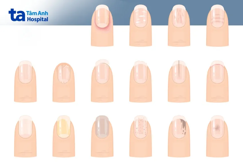 dấu hiệu bất thường của móng tay